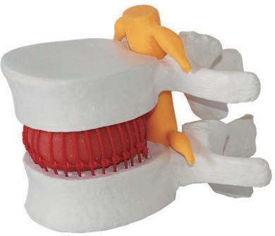 LUMBAR DISC HERNIATION MODEL