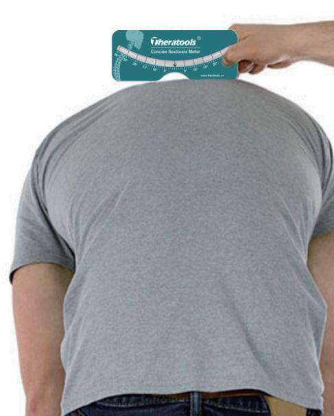 SCOLIOSIS MEASURING METER