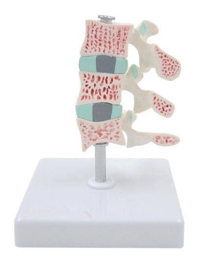 OSTEOPOROTIC MODEL
